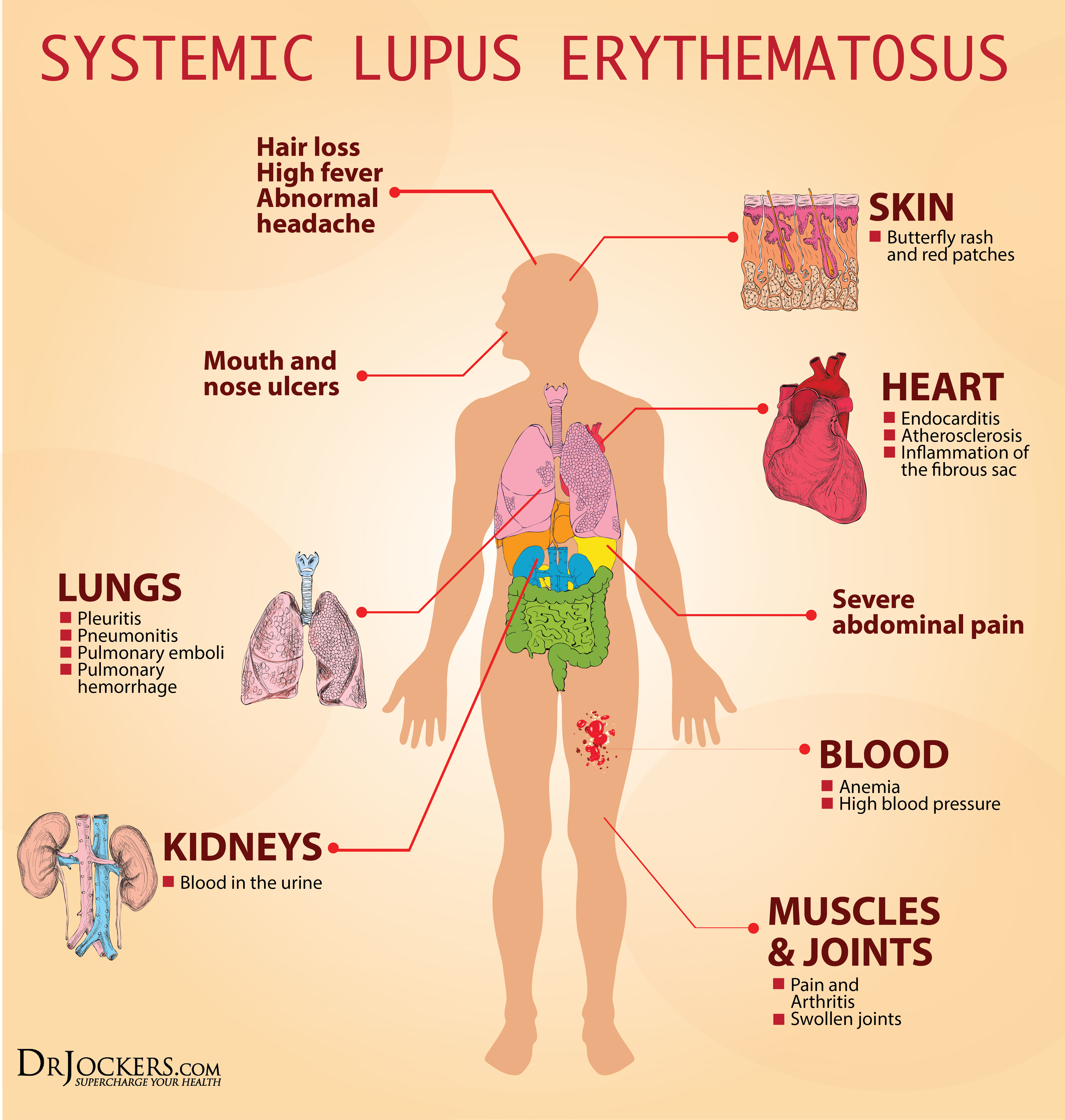 19 Ways to Heal Systemic Lupus Naturally