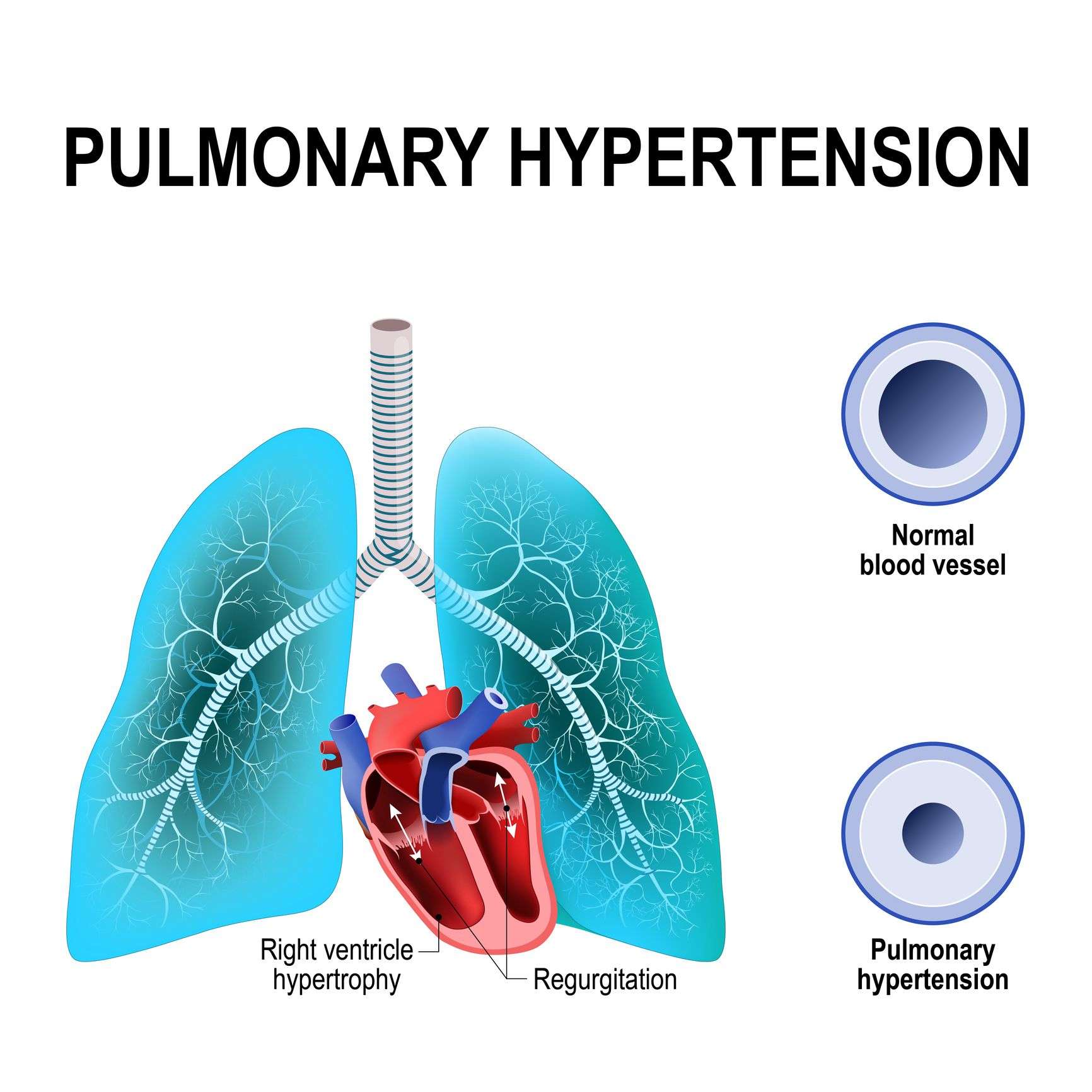 5 Types of Pulmonary Hypertension