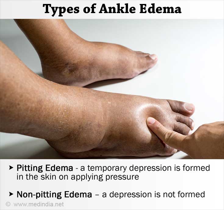 Ankle Edema / Ankle Swelling