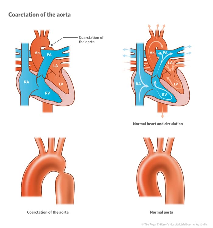 Cardiology : Coarctation of the Aorta HD