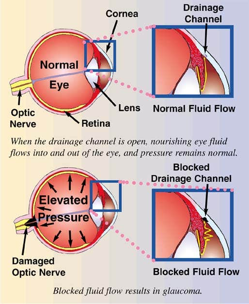 Glaucoma Care: Fundamental For Vision