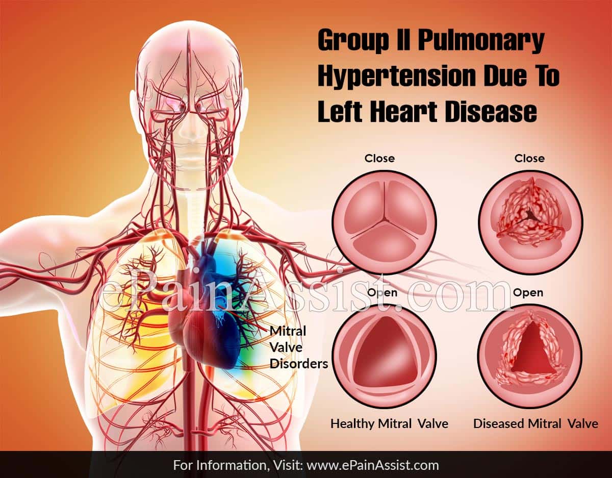 Group II Pulmonary Hypertension due to Left Heart Disease