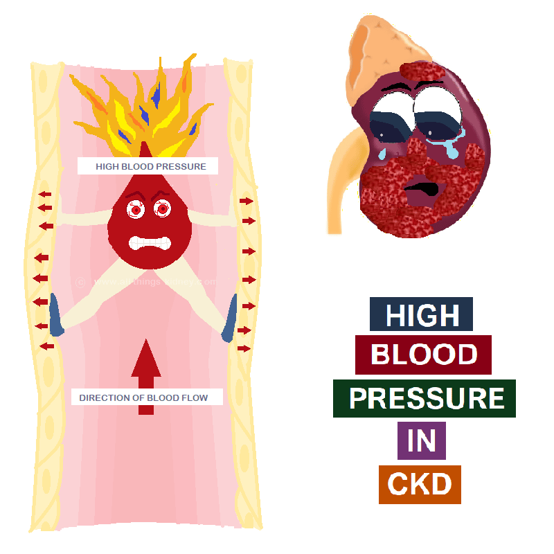 High Blood Pressure in CKD