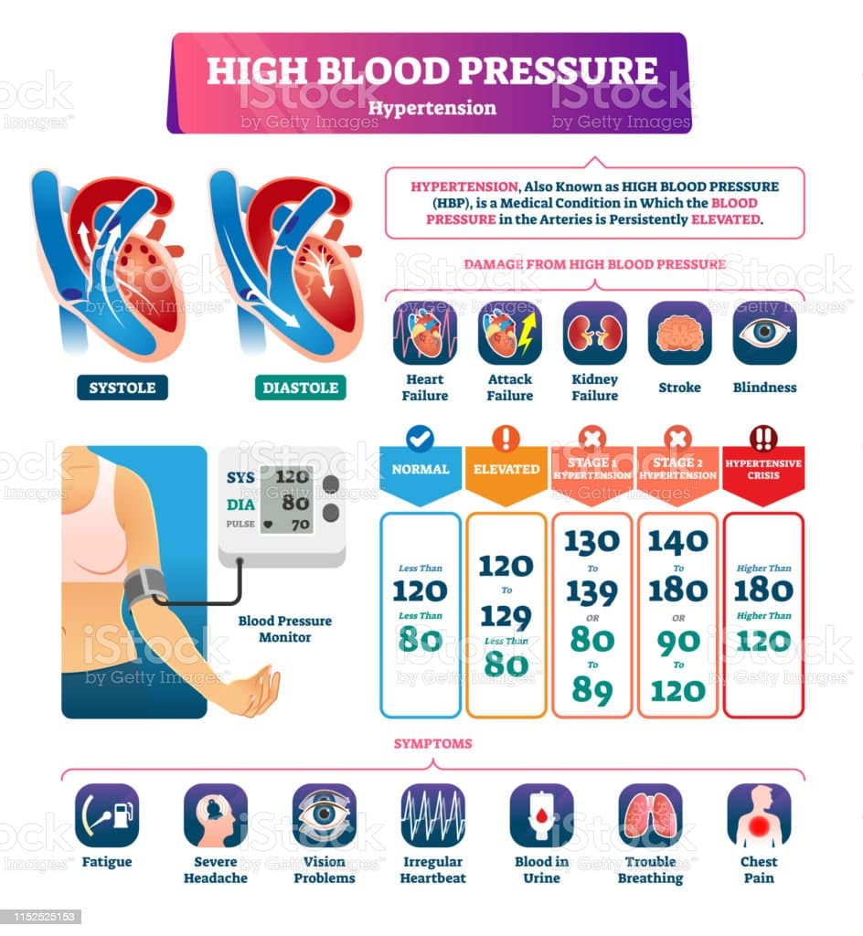 High Blood Pressure Vector Illustration Labeled Systole Explanation ...