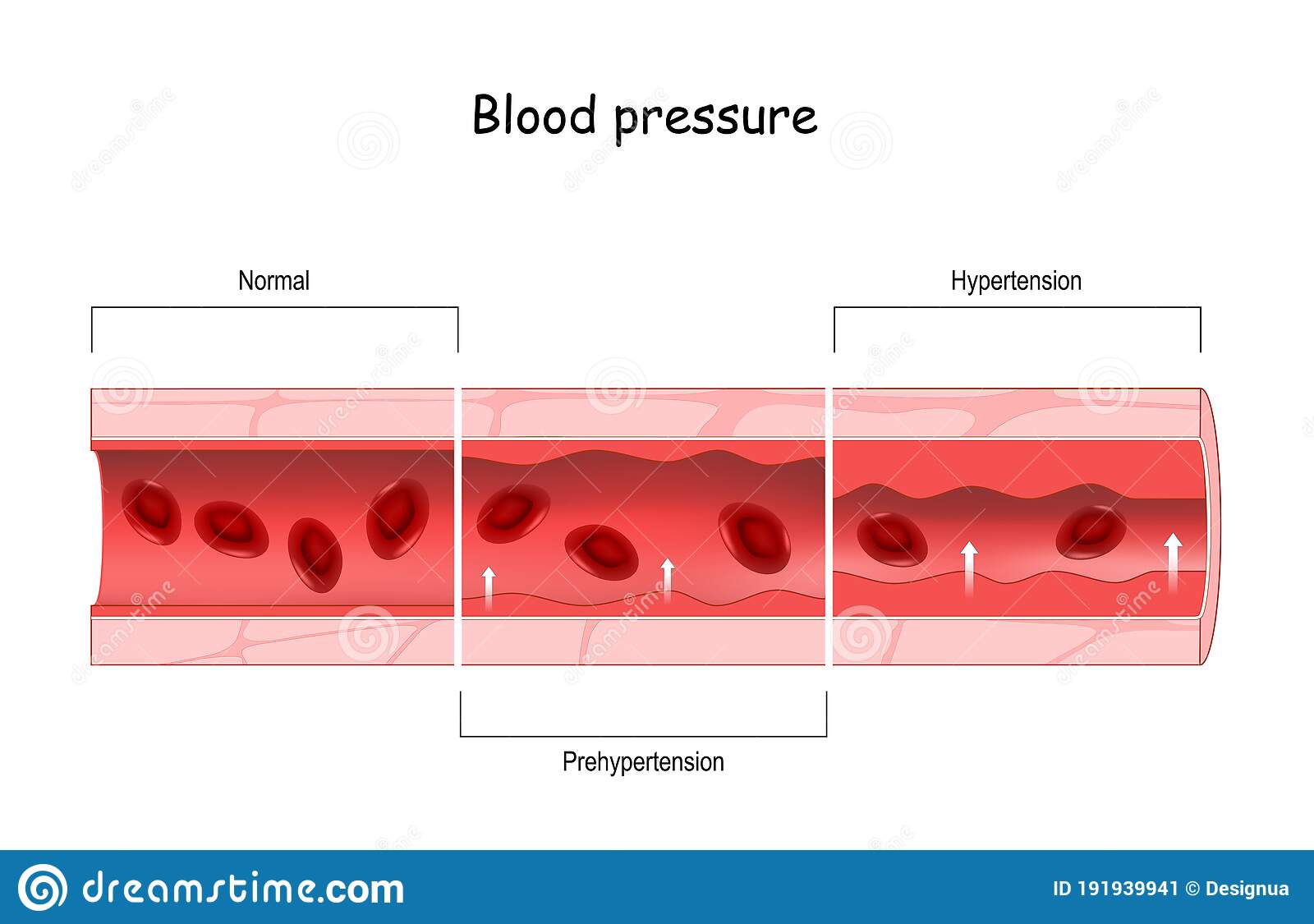 Hypertension. High Blood Pressure. Cross Section of Blood ...