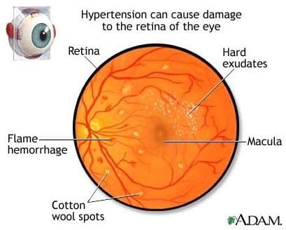 Learn about Eye Symptoms of High Blood Pressure