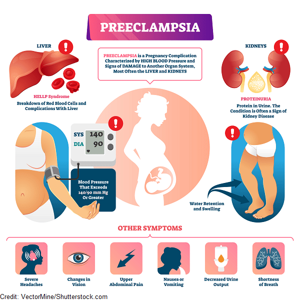 Preeclampsia &  Eclampsia Nursing Maternity Review