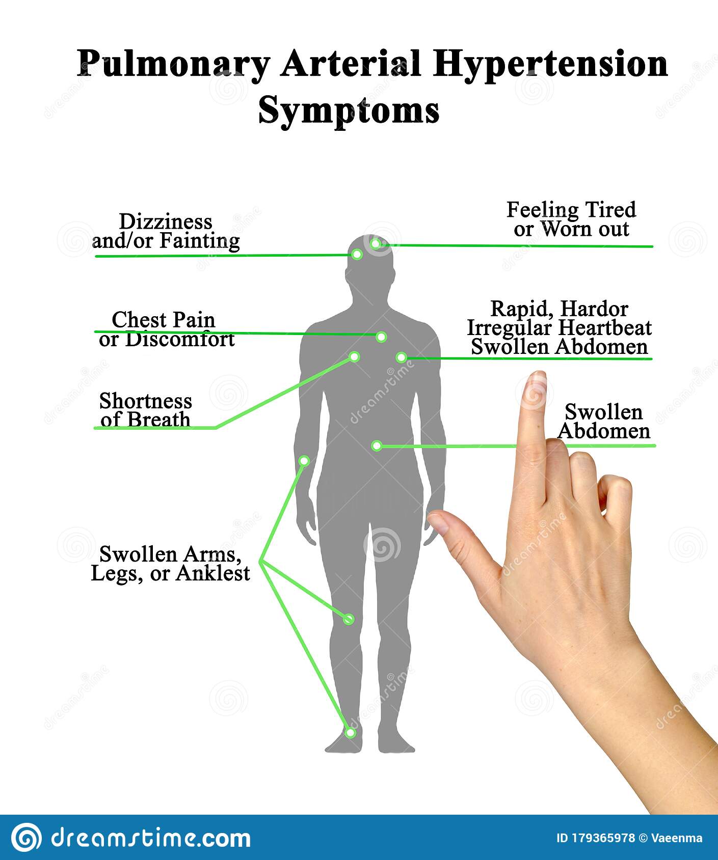 Pulmonary Arterial Hypertension Symptoms Stock Photo ...