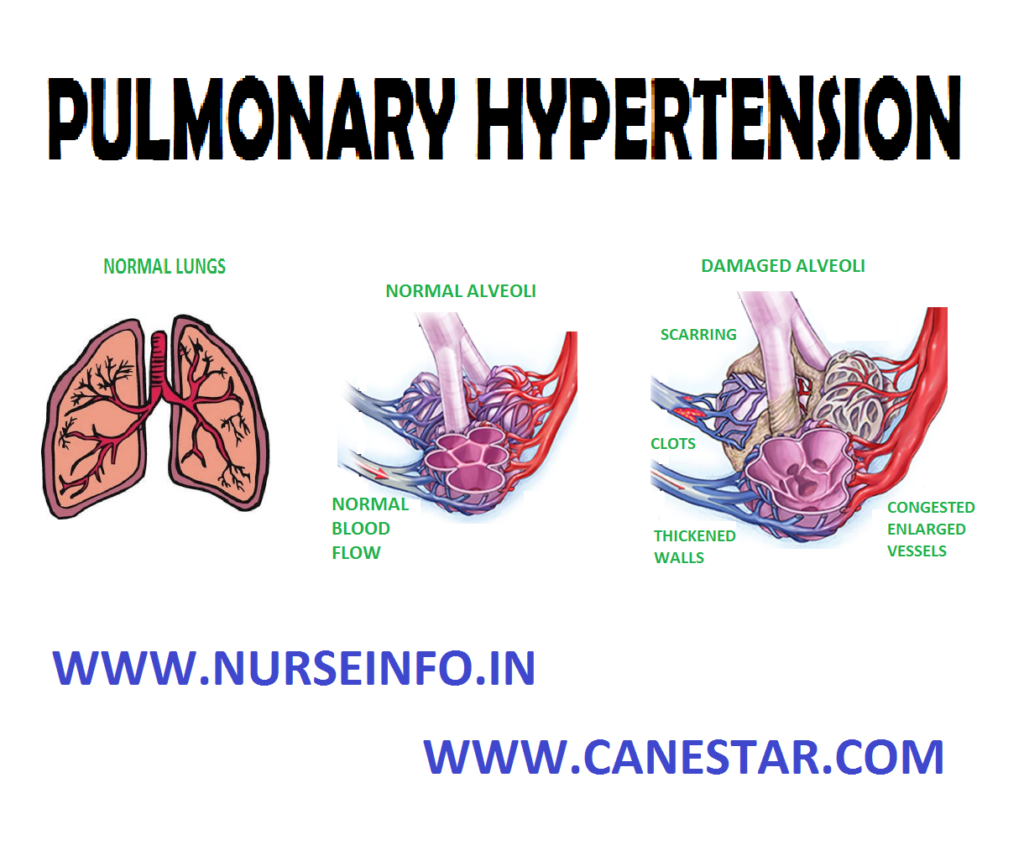 PULMONARY HYPERTENSION â Introduction, Types, Etiology, Pathophysiology ...