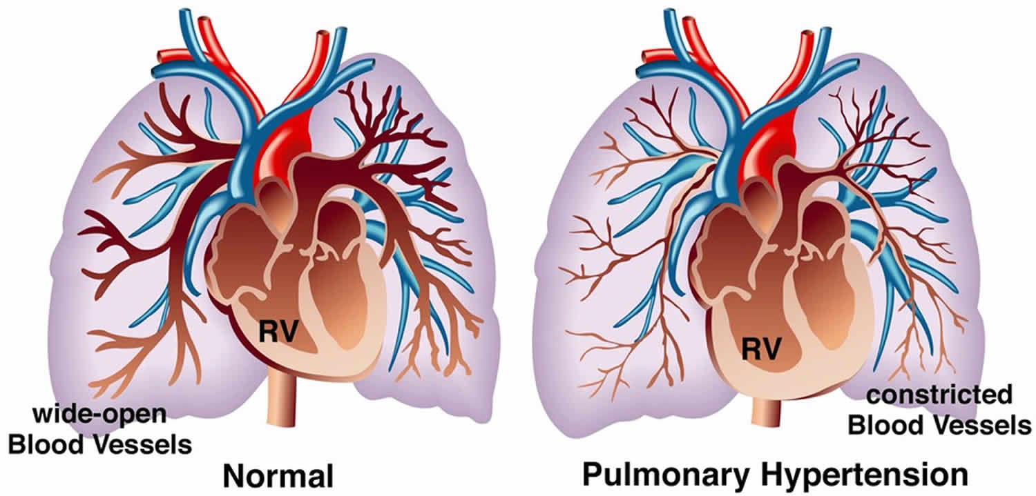 Pulmonary hypertension &  pulmonary arterial hypertension ...