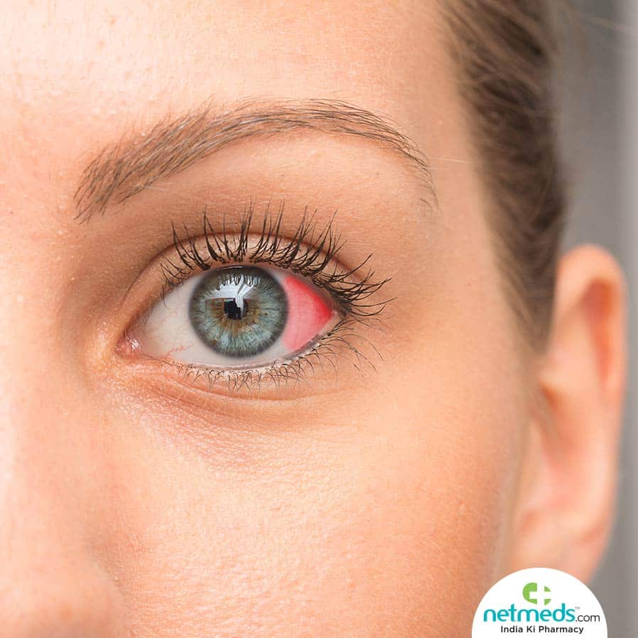 Red Spot On Eye: Causes, Symptoms And Treatment