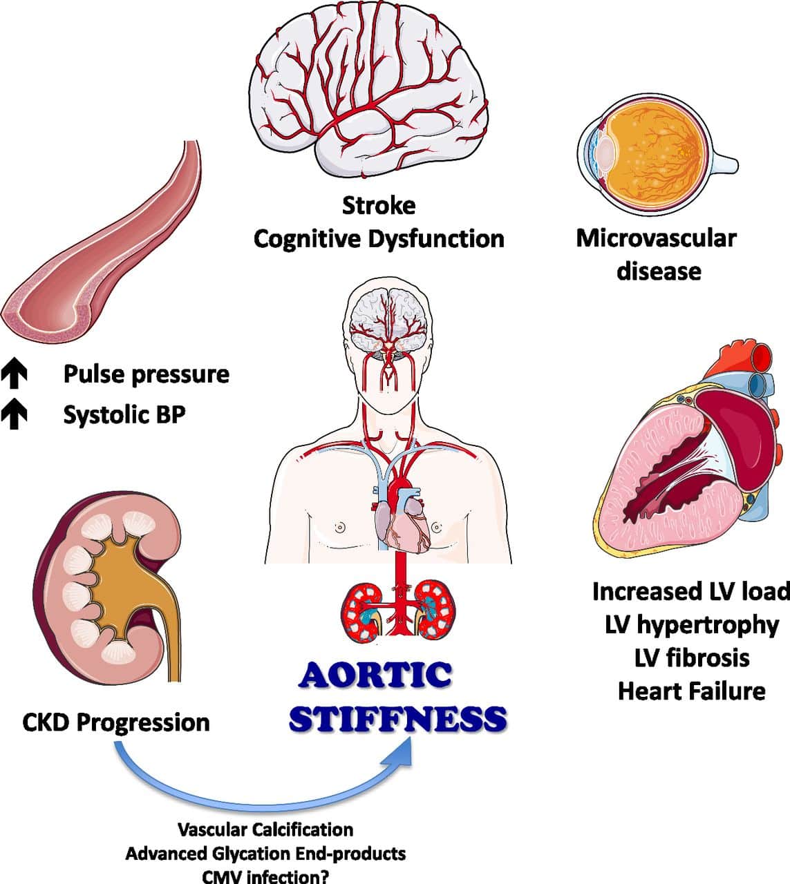 Reducing Arterial Stiffness in CKD: Revising the Paradigms