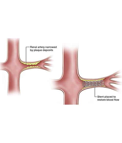 Renal Artery Stenosis Stenting in Vadodara