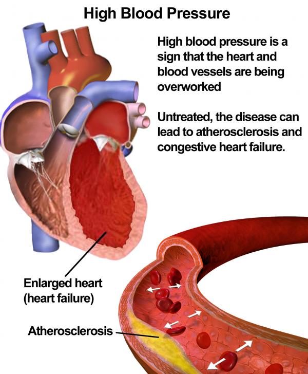 Simple Guidance For Tackling High and Low Blood Pressure.