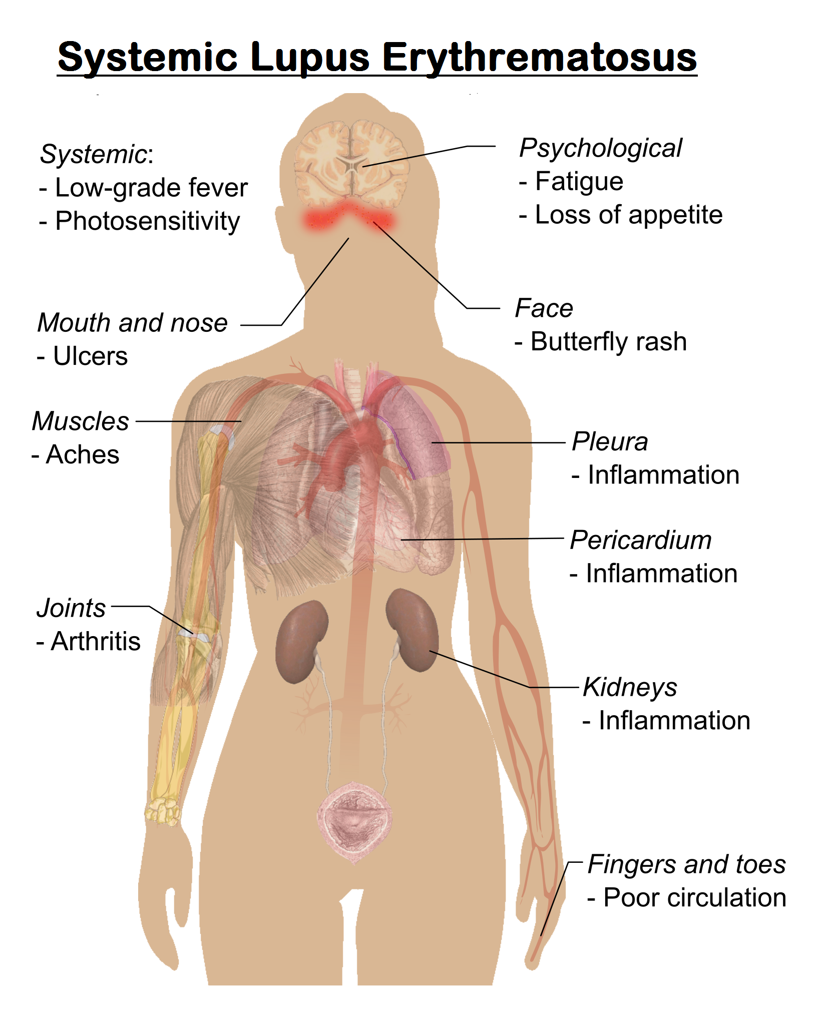 Systemic Lupus Erythematosus (SLE) : Causes &  Risk Factors ...