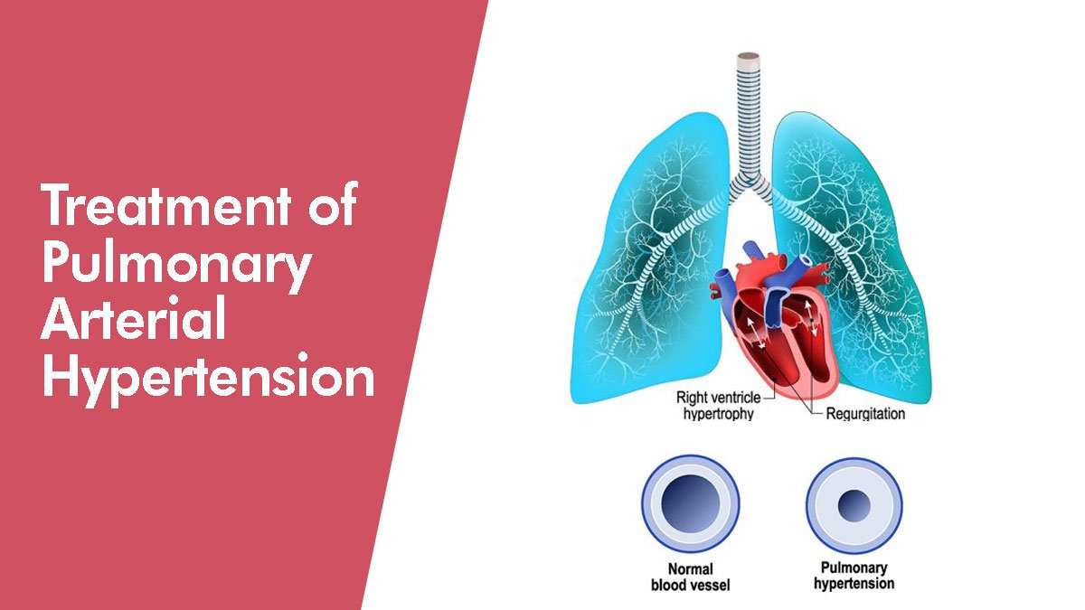 Treatment of Pulmonary Arterial Hypertension